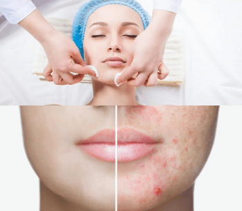 Acne Finish - 2 Sessões de acne Finish + 1 sessão de limpeza de pele profunda + 1 Sessão de revitaOxC